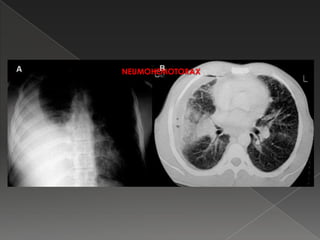 NEUMOHEMOTORAX
 