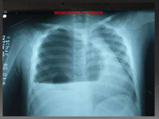 NEUMOTORAX A TENSION
 