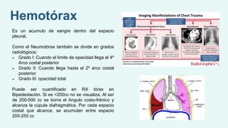 Es un acumulo de sangre dentro del espacio
pleural.
Como el Neumotórax también se divide en grados
radiológicos:
● Grado I: Cuando el limite de opacidad llega al 4º
Arco costal posterior
● Grado II: Cuando llega hasta el 2º arco costal
posterior
● Grado III: opacidad total
Puede ser cuantificado en RX tórax en
Bipedestación. Si es <200cc no se visualiza. Al ser
de 200-500 cc se borra el Angulo costo-frénico y
alcanza la cúpula diafragmática. Por cada espacio
costal que alcance, se acumulan entre espacio
200-250 cc
Hemotórax
 
