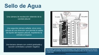Sello de Agua
Una cámara de recolección obtenido de la
cavidad pleural
Una segunda cámara sellada: sirve como
válvula de una dirección que permite la salida
de liquido del espacio pleural, impidiendo la
entrada al espacio
Una tercera cámara con control graduada y
succión controlada a presión negativa
Díaz-Rosales, Juan de Dios, & Enríquez-Dominguez, Lenin. (2010). PROCEDIMIENTO EN CIRUGÍA:
TORACOSTOMÍA CERRADA. Revista de la Facultad de Medicina, 58(4), 331-340. Retrieved October
21, 2021, from http://www.scielo.org.co/scielo.php?script=sci_arttext&pid=S0120-
00112010000400009&lng=en&tlng=es.
 
