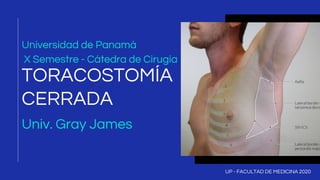 Universidad de Panamá
TORACOSTOMÍA
CERRADA
UP - FACULTAD DE MEDICINA 2020
X Semestre - Cátedra de Cirugía
Univ. Gray James
 