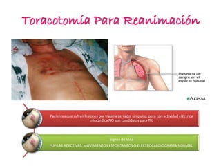 Toracotomía Para Reanimación
Pacientes que sufren lesiones por trauma cerrado, sin pulso, pero con actividad eléctrica
miocárdica NO son candidatos para TRI
Signos de Vida
PUPILAS REACTIVAS, MOVIMIENTOS ESPONTANEOS O ELECTROCARDIOGRAMA NORMAL.
