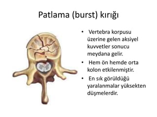 Patlama (burst) kırığı
           • Vertebra korpusu
             üzerine gelen aksiyel
             kuvvetler sonucu
             meydana gelir.
           • Hem ön hemde orta
             kolon etkilenmiştir.
           • En sık görüldüğü
             yaralanmalar yüksekten
             düşmelerdir.
 
