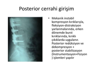 Posterior cerrahi girişim
             • Mekanik instabil
               kompresyon kırıklarıyla,
               fleksiyon-distraksiyon
               yarlanmalarında, erken
               dönemde burst
               kırıklarında, kırıklı
               çıkıklarda uygulanır.
               Posterior redüksiyon ve
               dekompresyon +
               posterior stabilizasyon
               (İnstrumentasyon+Füzyon
               ) işlemleri yapılır
 