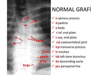 NORMAL GRAFİ
   n spinous process
   d pedicle
   a body
    t inf. end plate
   s sup. end plate
    cvj costovertebral joint
   trp transverse process
   tr trachea
   lsb left stem bronchus
   da descending aorta
   pss paraspinal line
 