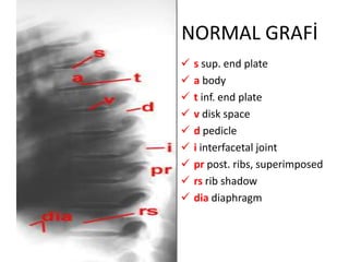 NORMAL GRAFİ
   s sup. end plate
   a body
   t inf. end plate
   v disk space
   d pedicle
   i interfacetal joint
   pr post. ribs, superimposed
   rs rib shadow
   dia diaphragm
 