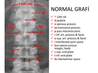 NORMAL GRAFİ
 * 12th rib
 d pedicle
 n spinous process
 tp transverse process
 p pars interarticularis
 r inf. art. process & facet
 o sup. art. process & facet
 i interfacetal joint space
 lcm lateral cortical
  margin, body
 s sup. end-plate
 t inf. end-plate
 ils interlaminar space
 