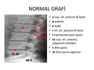 NORMAL GRAFİ
       o sup. art. process & facet
       d pedicle
       a body
       r inf. art. process & facet
       i interfacetal joint space
       o1 sup. art. process,
        subjacent vertebra
       v disk space
       S1 first sacral segment
 