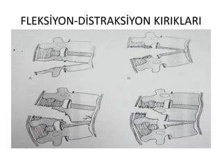 FLEKSİYON-DİSTRAKSİYON KIRIKLARI

•   .
 