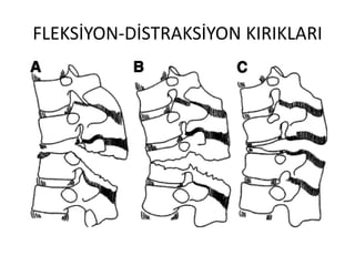 FLEKSİYON-DİSTRAKSİYON KIRIKLARI
 