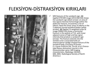 FLEKSİYON-DİSTRAKSİYON KIRIKLARI
                   MRI features of the sandwich sign. (A)
                    Sagittal STIR MR image (2915/30/150) shows
                    the sandwich sign (black arrow): an area of
                    low-signal-intensity hemorrhage within the
                    pedicular fracture, encased by a rim of
                    edema. Note the linear areas of edema in the
                    2 adjacent injured vertebral bodies (white
                    arrows). (B) Sagittal T2-weighted turbo SE
                    image (5000/120) shows a horizontal
                    fracture in the pedicle of T12, with linear
                    adjacent zones of high and low signal
                    intensity that produce a sandwich sign
                    (arrow). The fracture extends into the
                    vertebra and is associated with an
                    anterosuperior wedge-shaped fracture of the
                    vertebral body. (Courtesy of Groves
                    CJ, Cassar-Pullicino VN, Tins BJ, et al: Chance-
                    type flexion-distraction injuries in the
                    thoracolumbar spine: MR imaging
                    characteristics. Radiology 236:601–
                    608, 2005. Radiological Society of North
                    America.)
 