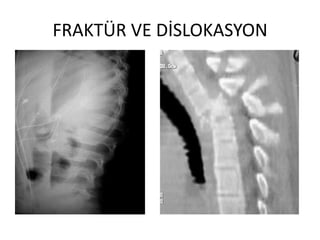 FRAKTÜR VE DİSLOKASYON
 