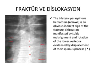 FRAKTÜR VE DİSLOKASYON
            The bilateral paraspinous
             hematoma (arrows) is an
             obvious indirect sign of the
             fracture-dislocation
             manifested by suble
             malalignment and rotation
             of the lower vertebra
             evidenced by displacement
             of their spinous process ( * )
 