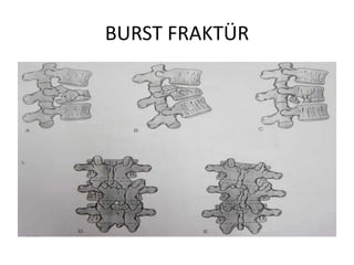 BURST FRAKTÜR
 