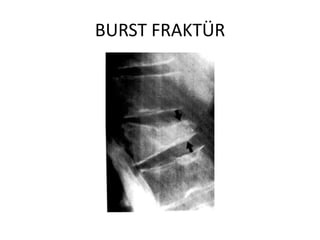 BURST FRAKTÜR
 