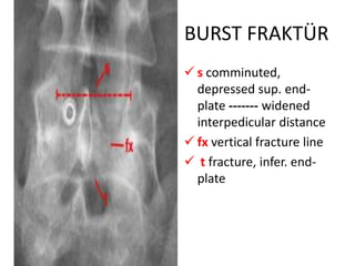 BURST FRAKTÜR
 s comminuted,
  depressed sup. end-
  plate ------- widened
  interpedicular distance
 fx vertical fracture line
 t fracture, infer. end-
  plate
 