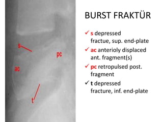 BURST FRAKTÜR
 s depressed
  fractue, sup. end-plate
 ac anterioly displaced
  ant. fragment(s)
 pc retropulsed post.
  fragment
 t depressed
  fracture, inf. end-plate
 