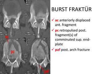 BURST FRAKTÜR
 ac anteriorly displaced
  ant. fragment
 pc retropulsed post.
  fragment(s) of
  comminuted sup. end-
  plate
 paf post. arch fracture
 