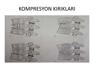 KOMPRESYON KIRIKLARI
 
