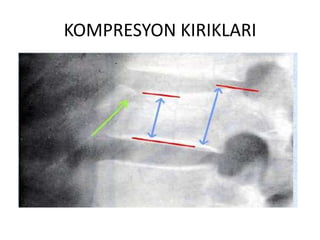 KOMPRESYON KIRIKLARI
 
