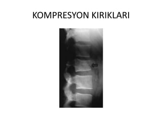 KOMPRESYON KIRIKLARI
 