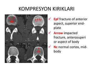 KOMPRESYON KIRIKLARI
           Epf fracture of anterior
            aspect, superior end-
            plate
           Arrow impacted
            fracture, anterosuperi
            or aspect of body
           Nc normal cortex, mid-
            body
 