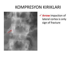 KOMPRESYON KIRIKLARI
           Arrow impaction of
            lateral cortex is only
            sign of fracture
 