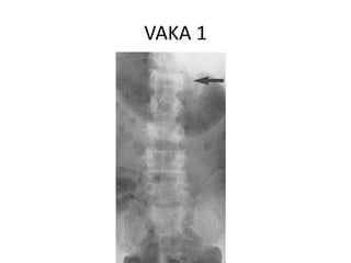 VAKA 1
 