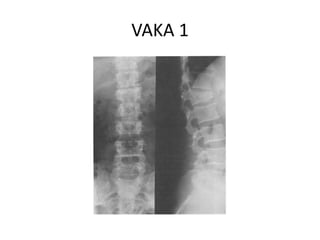 VAKA 1
 