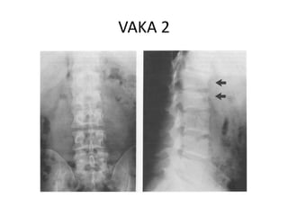 VAKA 2
 