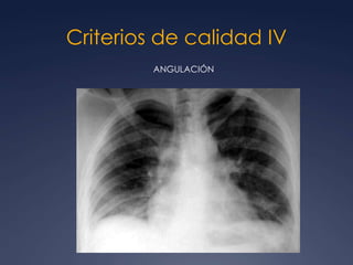Criterios de calidad IV
         ANGULACIÓN
 