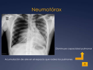 Neumotórax




                                         Disminuye capacidad pulmonar



Acumulación de aire en el espacio que rodea los pulmones
 