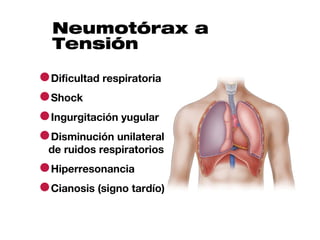 Neumotórax a
  Tensión

●Dificultad respiratoria
●Shock
●Ingurgitación yugular
●Disminución unilateral
 de ruidos respiratorios

●Hiperresonancia
●Cianosis (signo tardío)
 