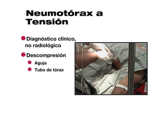 Neumotórax a
  Tensión

●Diagnóstico clínico,
 no radiológico

●Descompresión
  ● Aguja
  ● Tubo de tórax
 