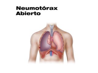 Neumotórax
Abierto
 