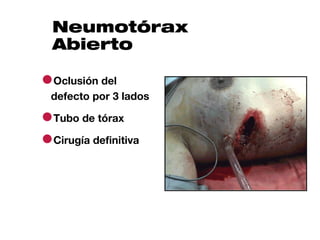 Neumotórax
  Abierto

●Oclusión del
 defecto por 3 lados

●Tubo de tórax
●Cirugía definitiva
 