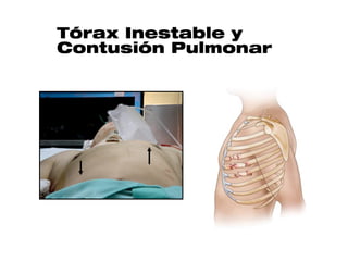 Tórax Inestable y
Contusión Pulmonar
 