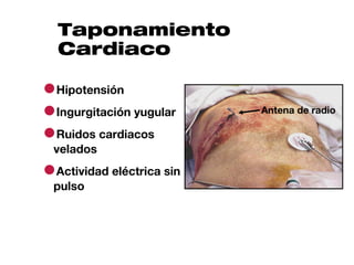 Taponamiento
  Cardiaco

●Hipotensión
●Ingurgitación yugular     Antena de radio

●Ruidos cardiacos
 velados

●Actividad eléctrica sin
 pulso
 
