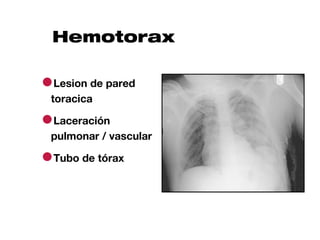 Hemotorax

●Lesion de pared
 toracica

●Laceración
 pulmonar / vascular

●Tubo de tórax
 