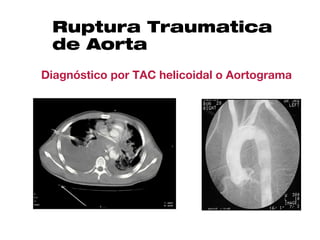 Ruptura Traumatica
 de Aorta
Diagnóstico por TAC helicoidal o Aortograma
 