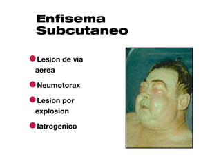 Enfisema
 Subcutaneo

●Lesion de via
 aerea

●Neumotorax
●Lesion por
 explosion

●Iatrogenico
 