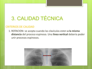 3. CALIDAD TÉCNICA
CRITERIOS DE CALIDAD
1. ROTACION: se acepta cuando las clavículas esten a la misma
distancia del proceso espinoso. Una linea vertical deberia poder
unir procesos espinosos.
 
