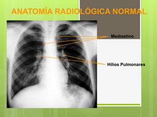 ANATOMÍA RADIOLÓGICA NORMAL
Hilios Pulmonares
Mediastino
 