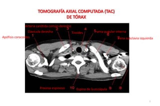 Apófisis coracoides
Clavícula derecha
Arteria carótida común derecho
Tiroides vena yugular interna
Vena subclavia izquierda
Espina de la escápulaProceso espinoso
1
 
