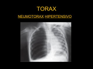 NEUMOTORAX HIPERTENSIVO
TORAX
 