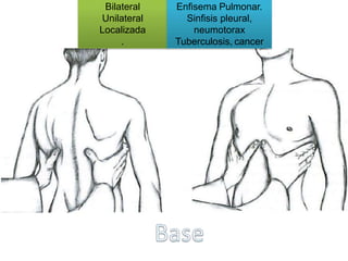 Bilateral
Unilateral
Localizada
.
Enfisema Pulmonar.
Sinfisis pleural,
neumotorax
Tuberculosis, cancer
 