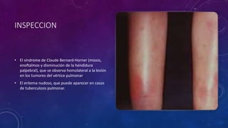 INSPECCION
• El síndrome de Claude Bernard-Horner (miosis,
enoftalmos y disminución de la hendidura
palpebral), que se observa homolateral a la lesión
en los tumores del vértice pulmonar
• El eritema nudoso, que puede aparecer en casos
de tuberculosis pulmonar.
 