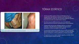 TÓRAX ESTÁTICO
• El tórax paralítico, plano o tísico se distingue por un
alargamiento del diámetro vertical y una reducción del
anteroposterior; puede ser una variante congénita normal o
la consecuencia de una tuberculosis crónica.
• En otros casos las deformaciones son el resultadod e
alteraciones de la columna vertebral (tórax cifoescoliótico).
• El desarrollo anormal del diafragma genera un tórax en
embudo o infundibuliforme (también llamado pectus
excavatum o tórax acanalado o de zapatero).
• El crecimiento desproporcionado de las costillas provoca el
denominado tórax en carena o en quilla o en pecho de pollo
(pectus carinatum), el tórax piriforme y el tórax piramidal
• El raquitismo, con su típico rosario raquítico, también altera
la conformación torácica normal.
 