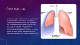TÓRAX ESTÁTICO
• Unilaterales: estas deformaciones se expresan por
abovedamientos y retracciones. Se observan
fundamentalmente en los niños, que mantienen
una amplia elasticidad torácica. En los pacientes
con un derrame pleural voluminoso o con
neumotórax a tensión, se produce el
abovedamiento del hemitórax afectado; en sentido
inverso, al sínfisis pleural, la paquipleuritis y la
atelectasia por obstrucción retraen la pared costal.
 