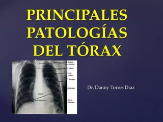 {
PRINCIPALES
PATOLOGÍAS
DEL TÓRAX
Dr. Danny Torres Diaz
 